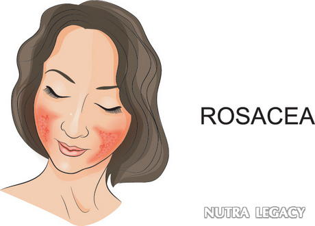 Blood Vessels And Rosacea - 5 Of The Most Effective Rosacea Remedies