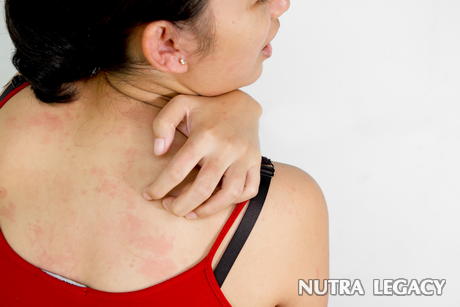 Top 10 Ways To Cure Itchy Rash
