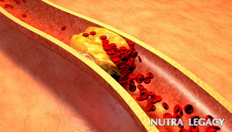 Treatments For Clogged Arteries - 7 Remedies To Clean Clogged Arteries