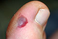 Blood Blisters Can Be a Warning Sign of Skin Cancer
