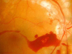 Bleeding Blood Vessels