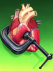 Hypertension Heart Disease
