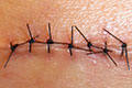 Get the Wound Stitched