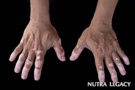 5 Facts about Vitiligo
