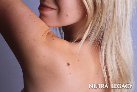 7 Facts about Birthmarks