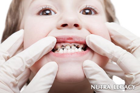 Tooth Decay In Children