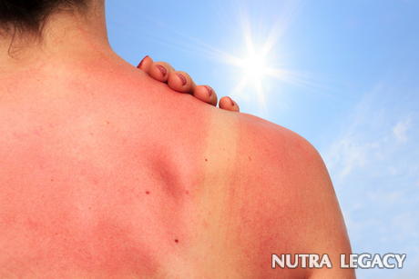 Sun Damaged Skin