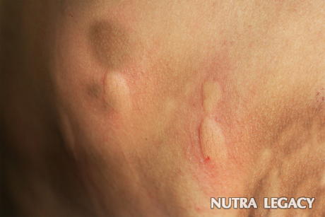 Spider Bites Treatment Spider Bites Treatment