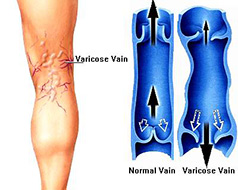 Varicose Veins Treatment