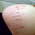 Stretch Marks Prevention