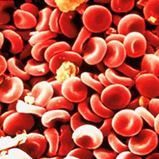 Vitamin B12 Deficiency