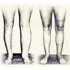 Leg Cellulitis