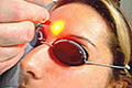 Laser Wart Treatment