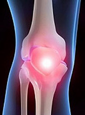 Inflammatory Arthritis